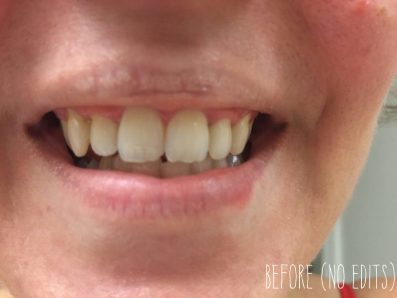 How I brightened my smile quickly and easily - Luster Premium White Review